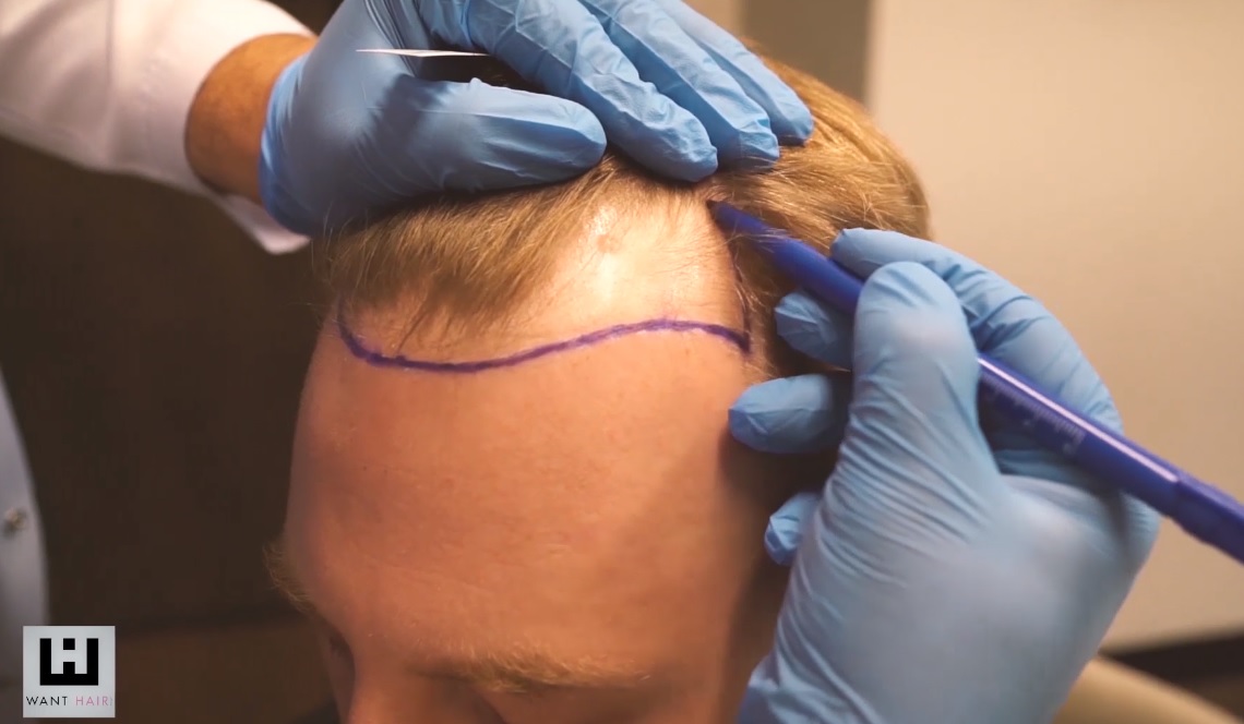 hair transplant Istanbul