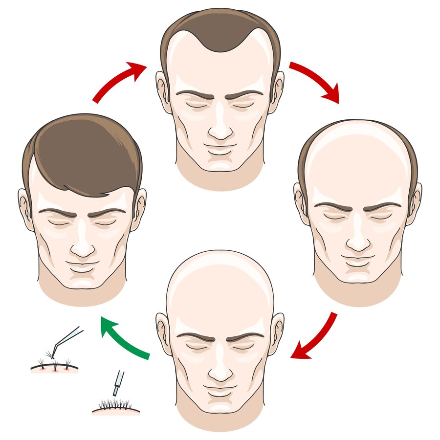 hair transplant