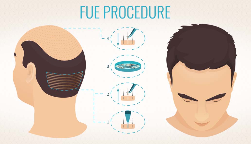 FUE Hair Transplant