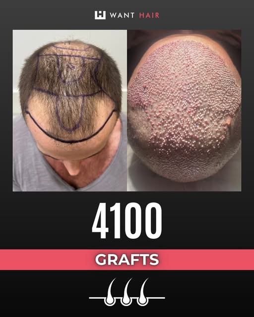 hair loss clinic