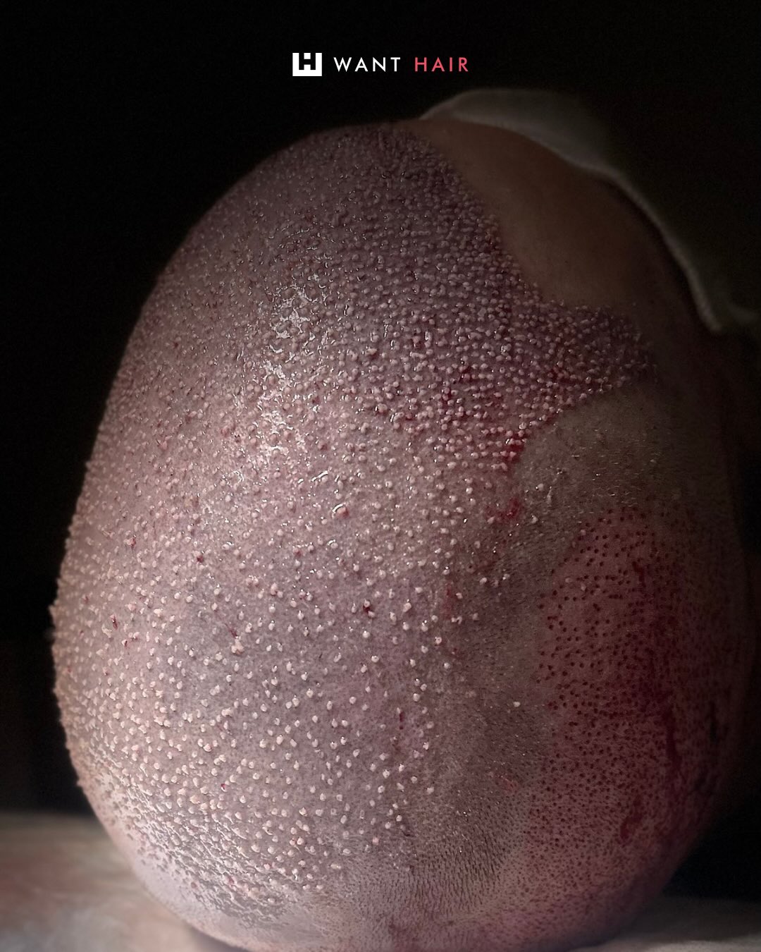 FUE Hair Transplant in Turkey