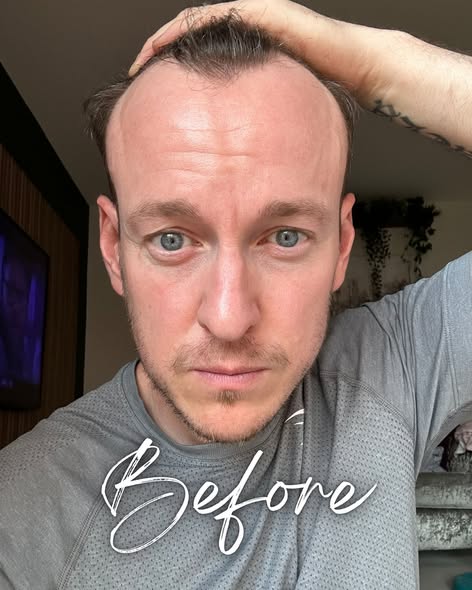 UK Hair Transplant Clinic Manchester