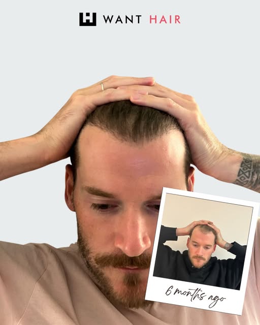 Hair Transplant Turkey
