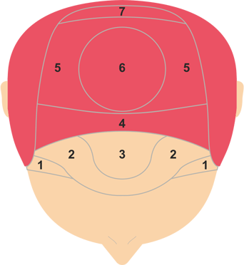 Norwood Scale of Baldness